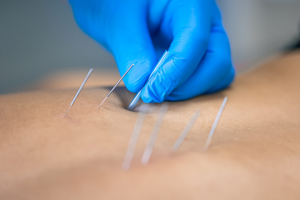 Close up of a needle and hands of physiotherapist doing a dry needling in a physiotherapy center.